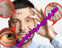 علائم کبد چرب در چهره، پوست و چشم: آزمایش در شیراز (1404)