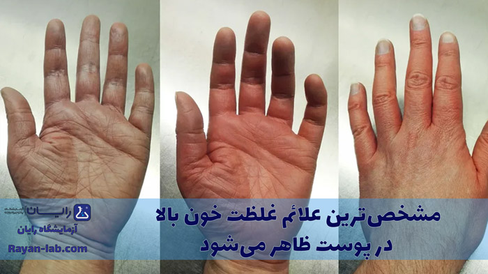 عوارض غلظت خون بالا روی پوست